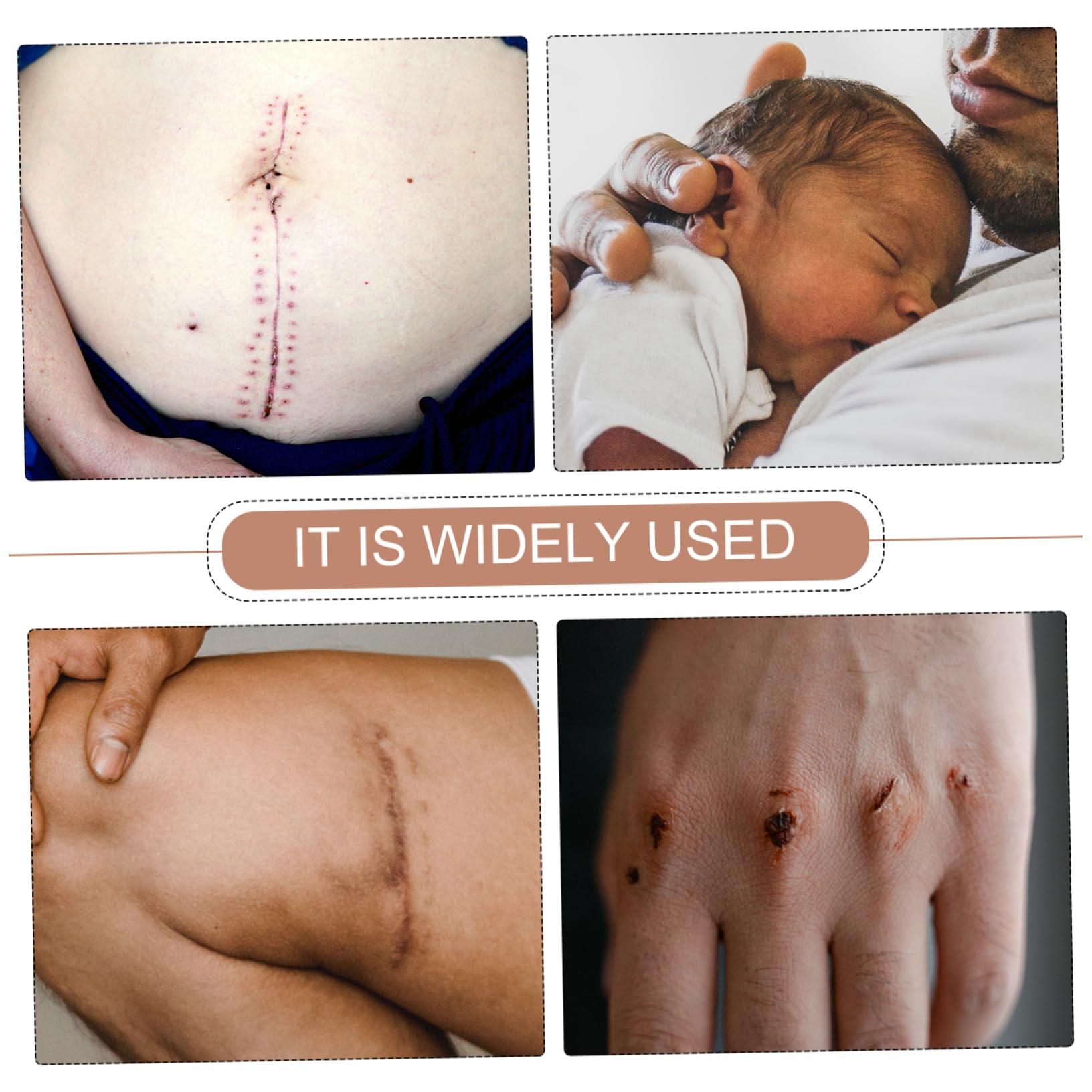 Hemoton Hemoton 5 Rolls Fade Scar Stickers Medical Patch Scar Dressings Waterproof Patches Scar Softening Stickers Cesarean Section Scar Bandages Lighten Scar Stickers Tape Baby Auricle