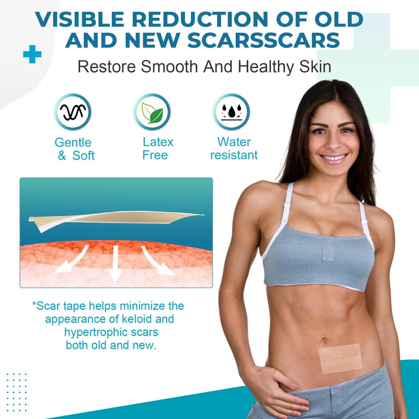 Rvlaim Silicone Scar Sheets, Silicone Scar Tape(1.6x 60 Roll-1.5M), Silicone Scar Strips, Professional Scar Removal Sheets for Surgical Scars, Keloid, C-Section, Burn et