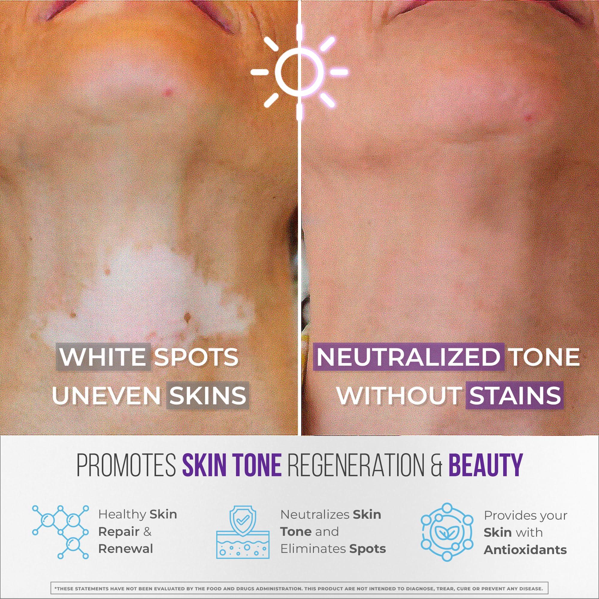 AURA VITAMINS AURA VITAMINS - Vitiligo Capsules 60 Count | 1 Month | Improve Skin Pigmentation Support and Reduce White Spots | Effective Vitiligo Supplement | Natural Solution for White Spots on Skin. (1)