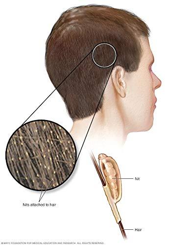 Cave Creek Trading Company, LLC Lice Comb Chemical Free Head Lice Treatment with Double Spiral Micro Grooved Comb Teeth