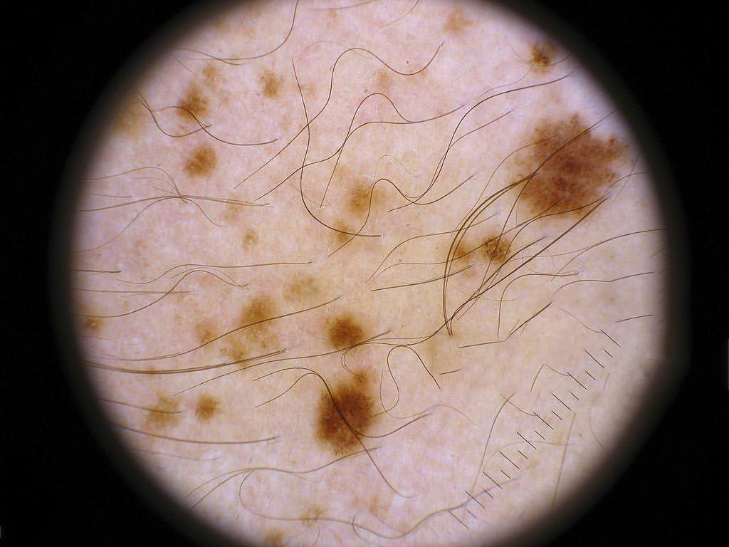 Iboolo&EooEye IBOOLO Professional Handheld 10X Magnify DE-4100 Dermatoscope