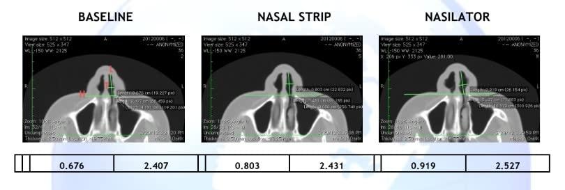 Nasilator Made in USA! Nasilator Anti-Snoring Devices - Soft and Flexible Nasal Dilators | Improves Breathing & Sleeping | Snoring Solution | Reusable & Better Than Nasal Strips Pack of 4 (Medium)