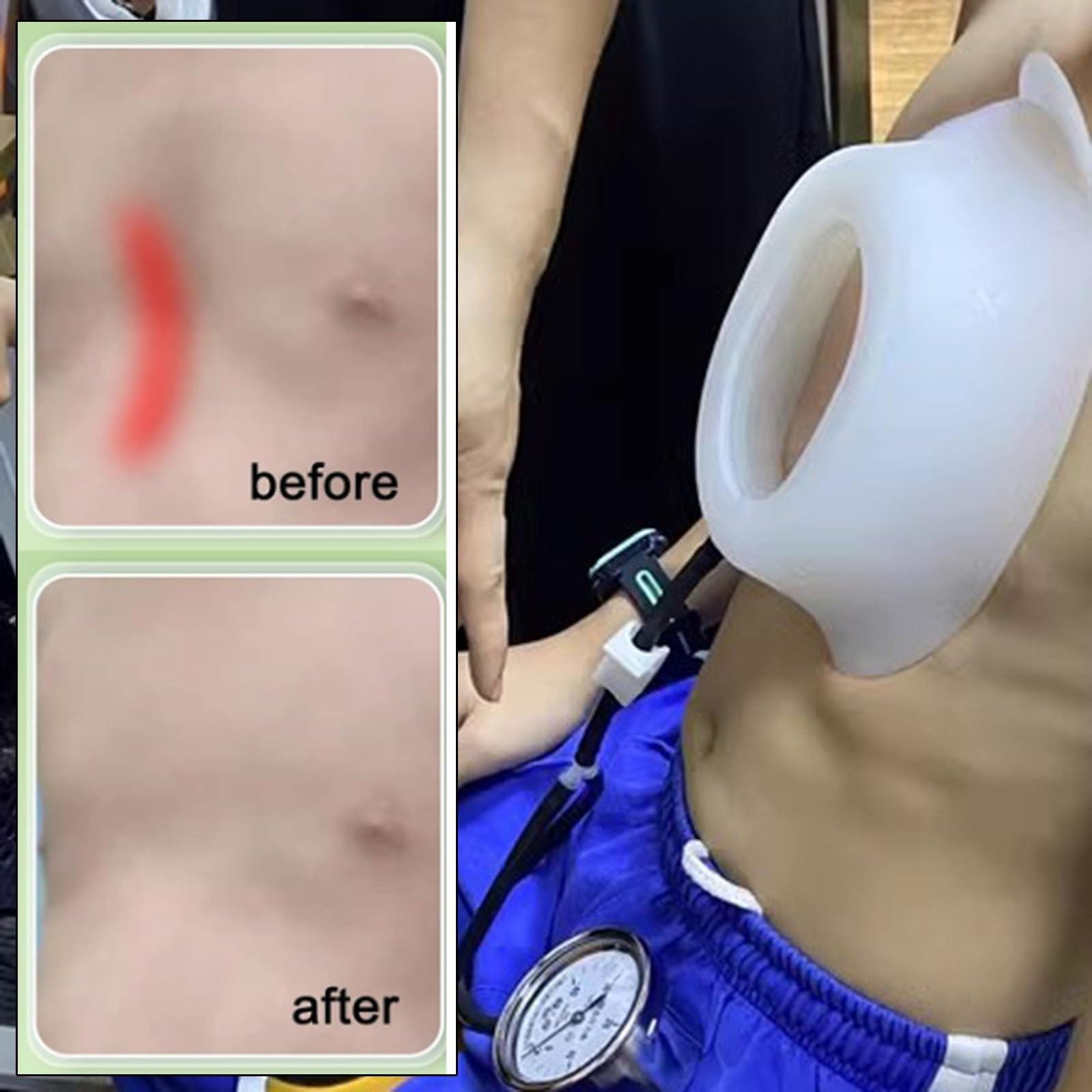 Taeoksn Taeoksn Pectus Carinatum Orthosis Brace,Pigeon Chest Support for Adult,Rib Valgus Correction Belt,Physical Correction of Pectus Carinatum,Free Adjustment(M-M)