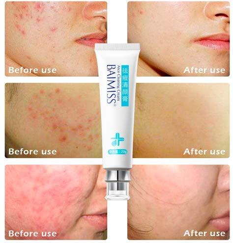 Tink knub BAIMISS Herbal Acne Treatment Cream 1PCS Remove Acne Scar Pimple Face Cream Skin Care Acne Send Removal Needle