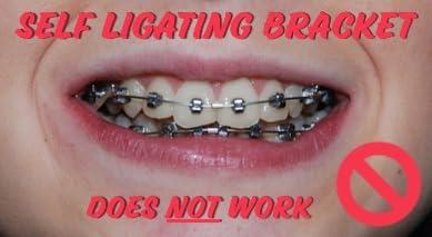 Snapcaps Snapcaps Braces Bumper Cover, Orthodontic Bracket Wax Substitute, Alternative Snap-on Braces Guard Braces Accessories 10 pack (Bow)