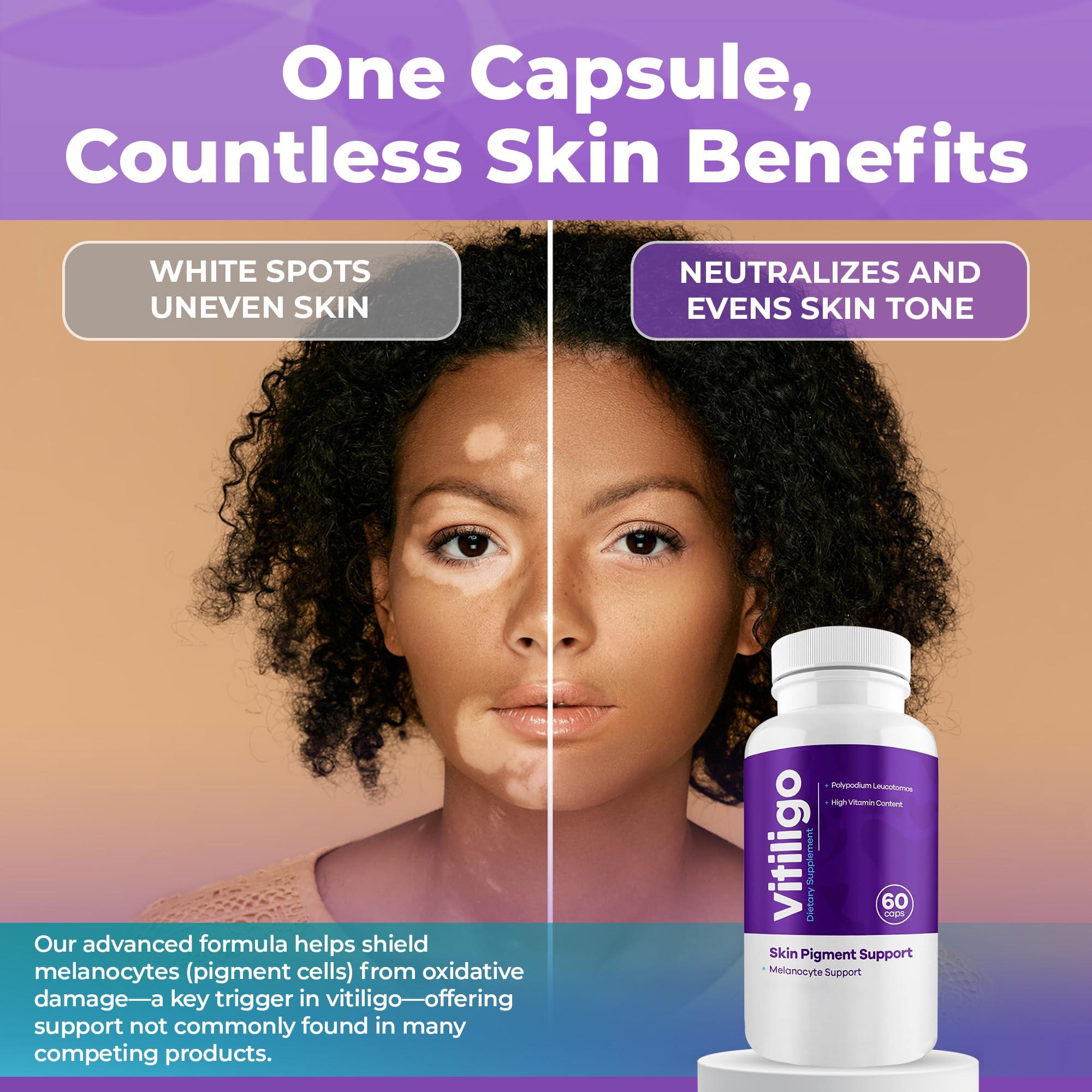 AURA VITAMINS AURA VITAMINS - Vitiligo Capsules 60 Count | 1 Month | Improve Skin Pigmentation Support and Reduce White Spots | Effective Vitiligo Supplement | Natural Solution for White Spots on Skin. (1)