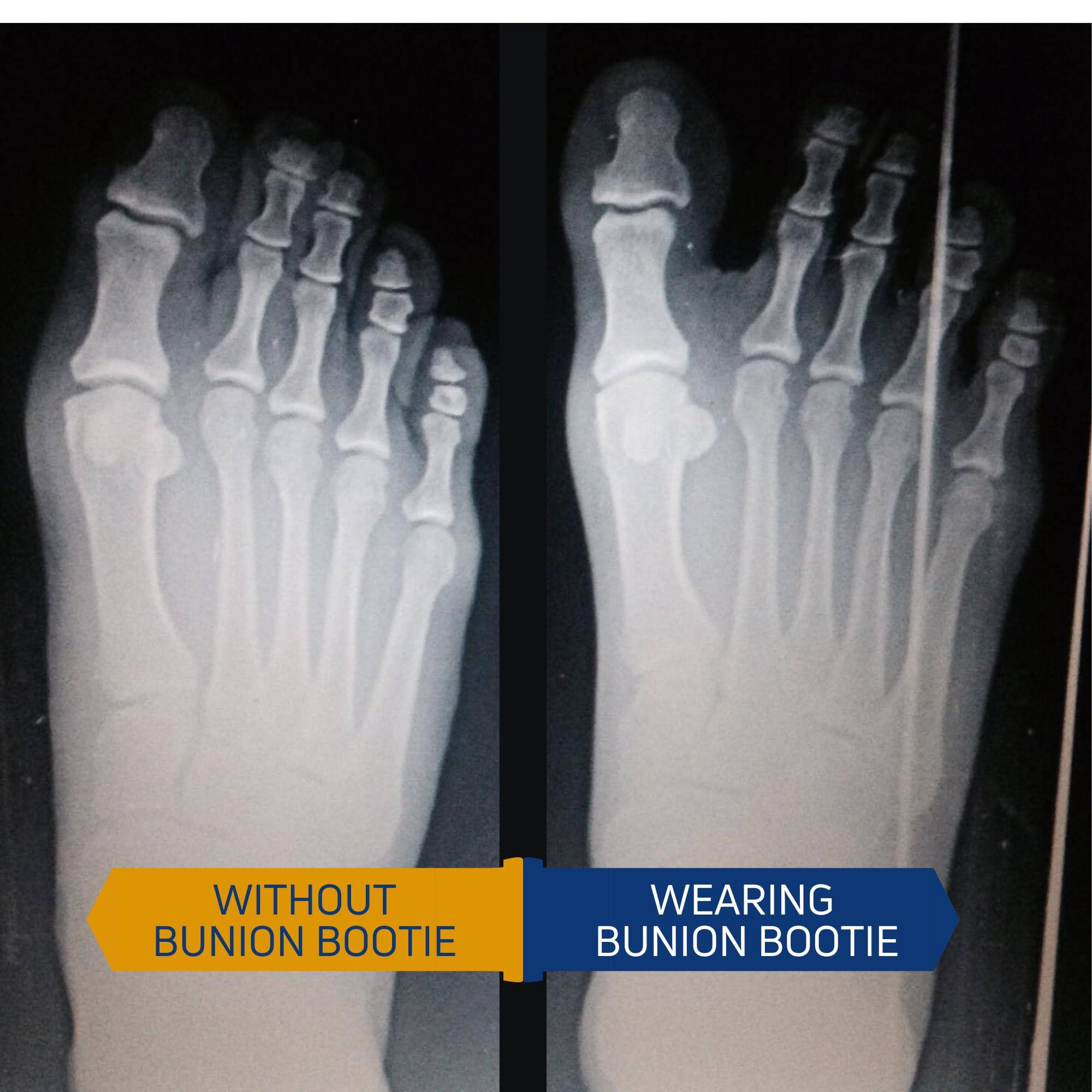 Bunion Bootie Bunion Corrector for Women Big Toe Straightener. Ultra Thin Support Brace for Inside Any Shoes. Great Toes Straightener Socks. Flexible Bunyon Splints for Day & Night. (Small-Right)