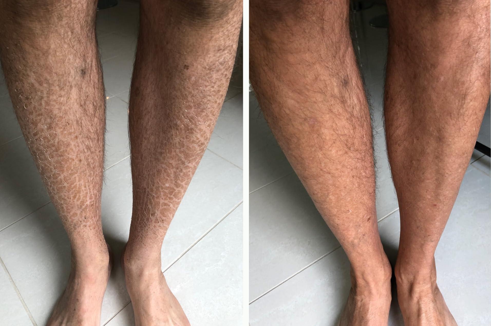 G16 Lotion G16 Skin Repair, Very Dry Skin & Ichthyosis Treatment Cream & Lotion