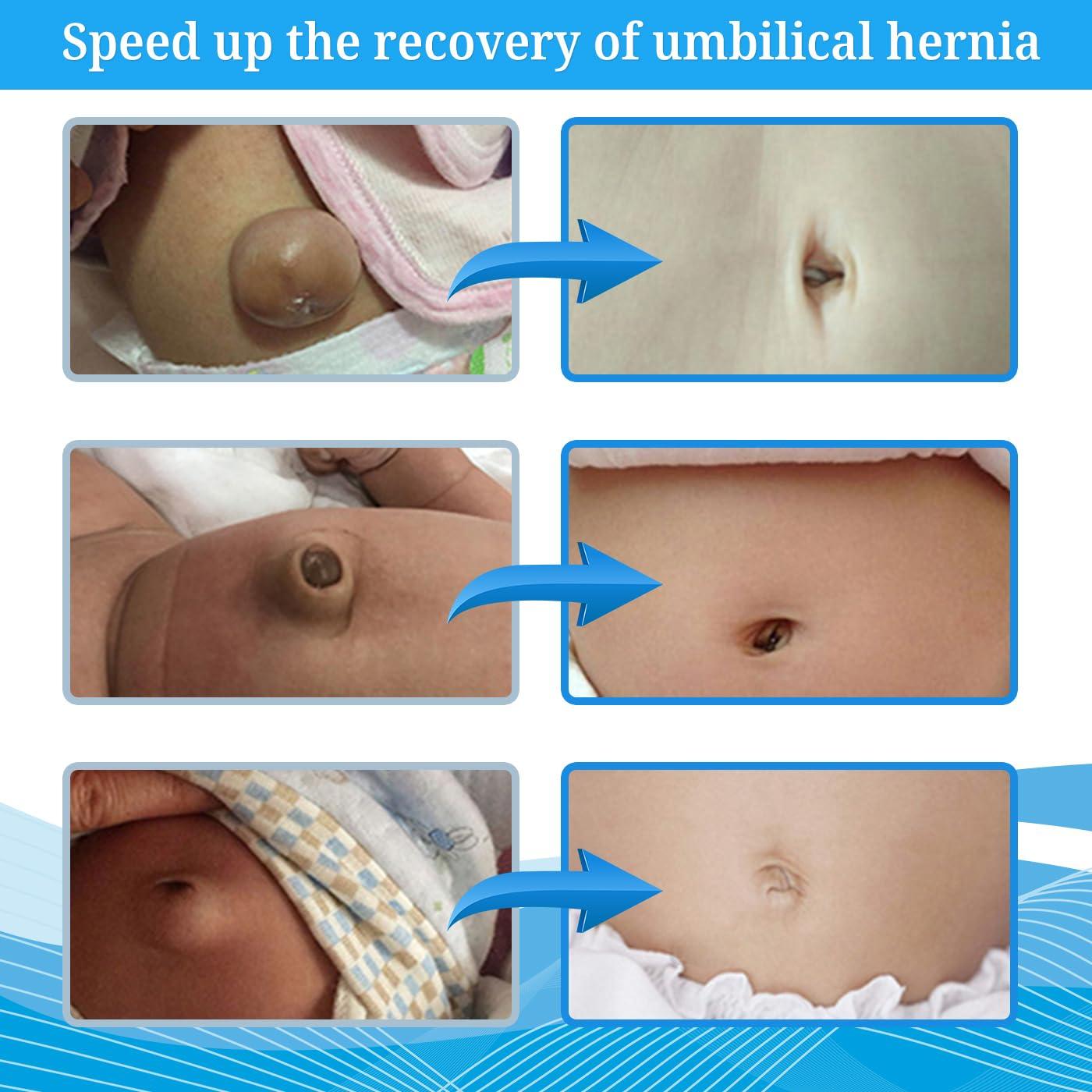 S S Baby Belly Band Umbilical Hernia Belt | Belly Button Band Navel Truss Wrap for Newborn/Infant - Soft, Skin-friendly, Adjustable