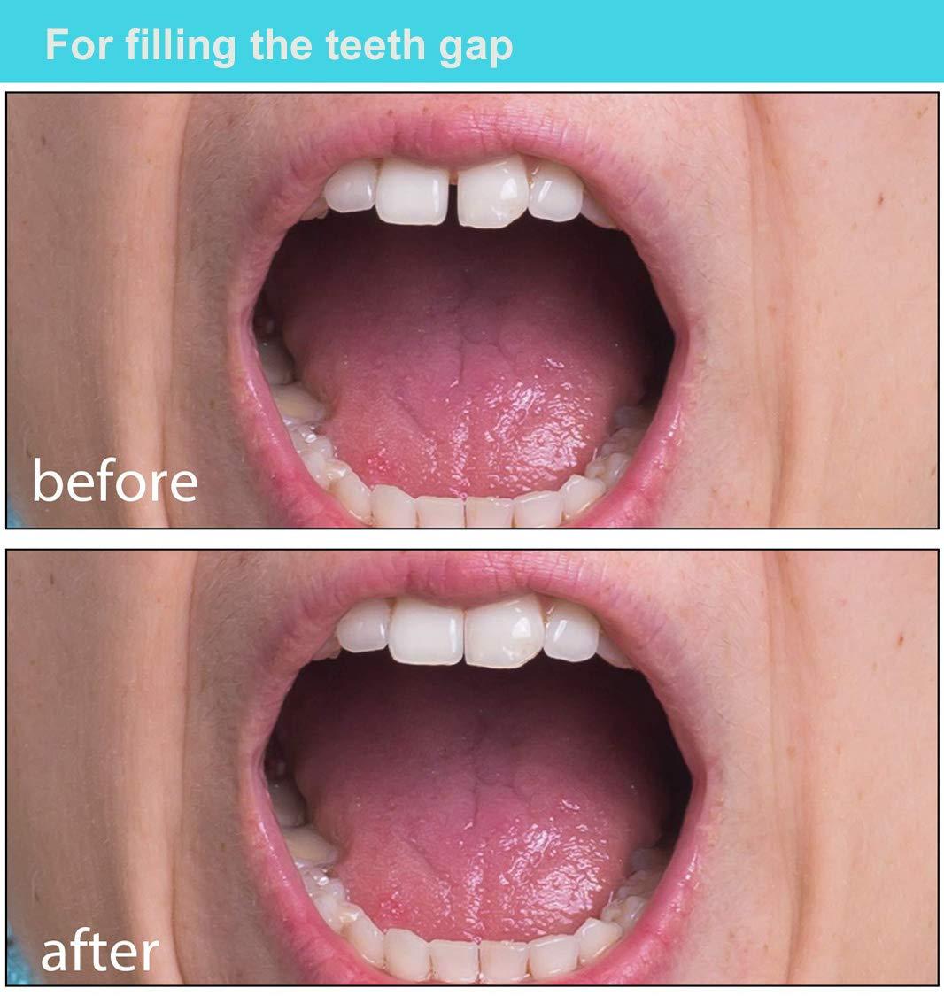 Brige Brige Tooth Repair kit for Filling The Missing Broken Tooth and Gaps-Moldable Fake Teeth and Thermal Beads Replacement Kit