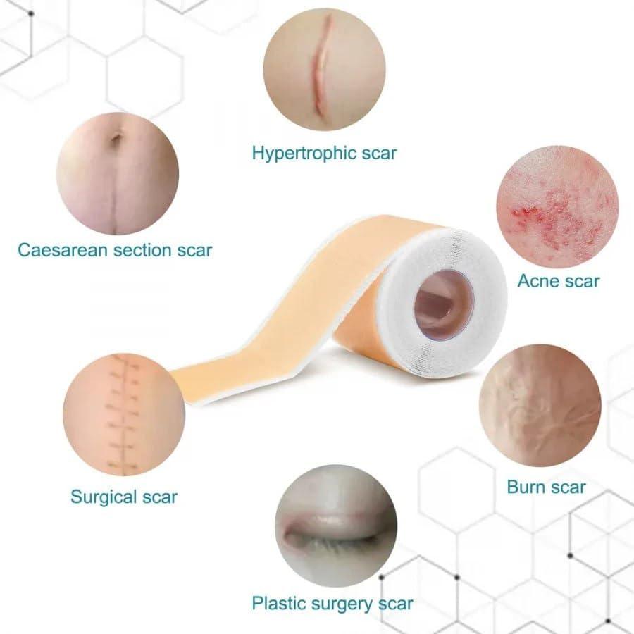 DHAMELIYA DD Silicone Scar Sheets, Silicon Gel Sheets for Scars Transparent Medical Silicone Gel Tape for Scar Removal, Silicone Scar Tape Roll for Hypertrophic Scars and Keloids Caused by Surgery