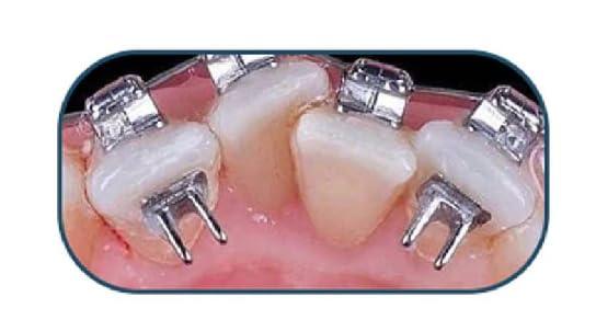 Dentalmall Dentalmall Bite Turbos Opener Lingual Rest Bite-Builder Wing Tongue Tamers Crib 100 Pieces