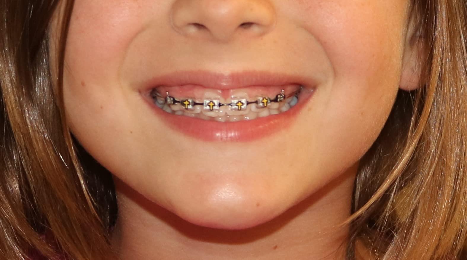 Snapcaps Snapcaps Braces Bumper Cover, Orthodontic Bracket Wax Substitute, Alternative Snap-on Braces Guard Braces Accessories 10 pack (Cross)