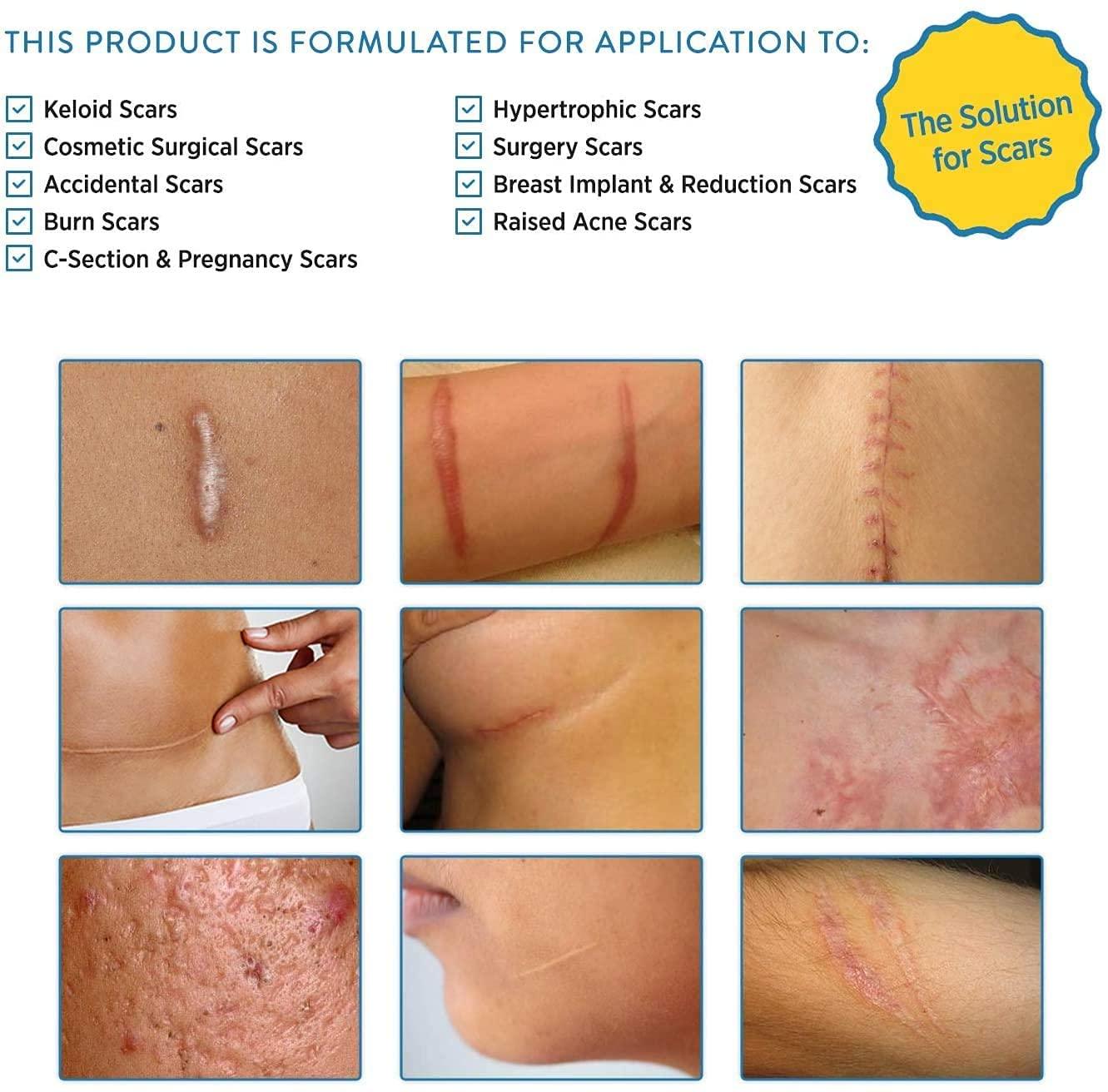 Aroamas Scar Aroamas Scar Silicone Scar Tape Softens & Flattens Scars from Surgery, Injury, Burns, C-Section, Scratch Marks  Reusable Medical-Grade Silicone Scar Sheets for All Skin Types [3\"x1.57\", 8 Sheets]