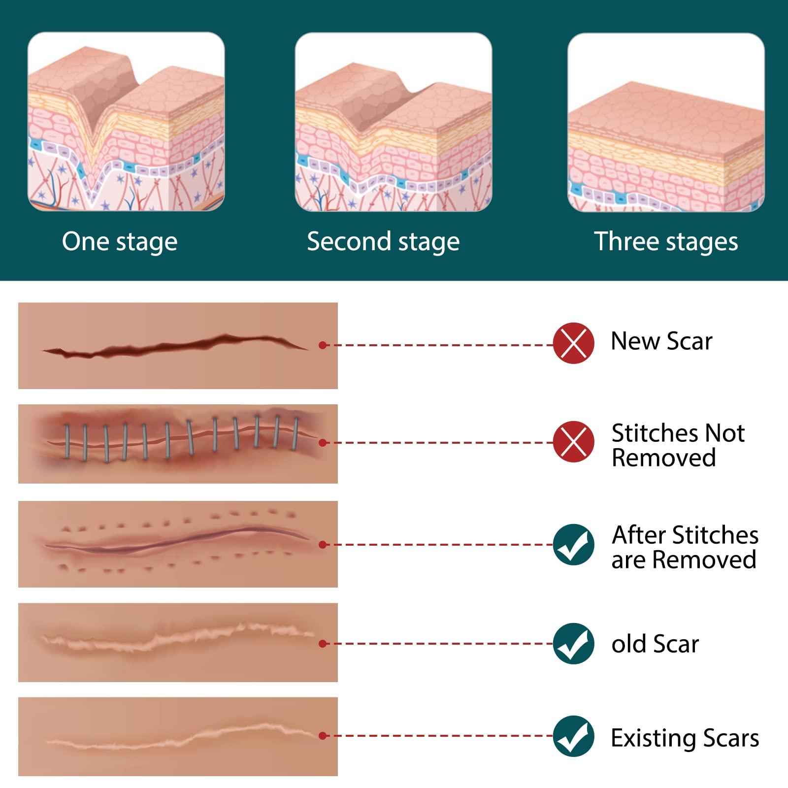 RTBYUE Silicone Scar Sheets,Professional Silicone Tape for Scars(16 pads-5.9x 1.6),Silicone Scar Tape,Scar Removal Sheets,Silicone Scar Strips for Surgical Scars, C-Section, Surgery, Burn, Keloid, Acne