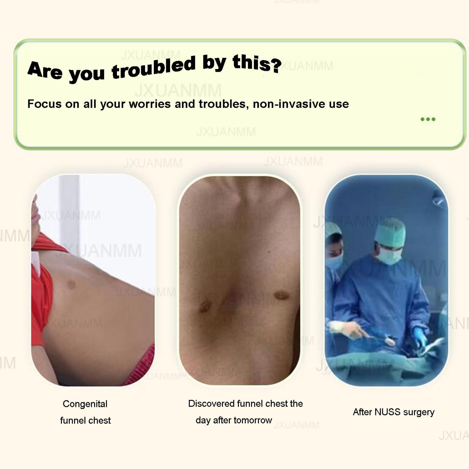 JXUANMM JXUANMM Pectus Excavatum Orthosis Brace,Pectus Excavatum Vacuum Bell - Pectus Excavatum Orthosis Brace,Chest Support,with Pressure Gauge,S