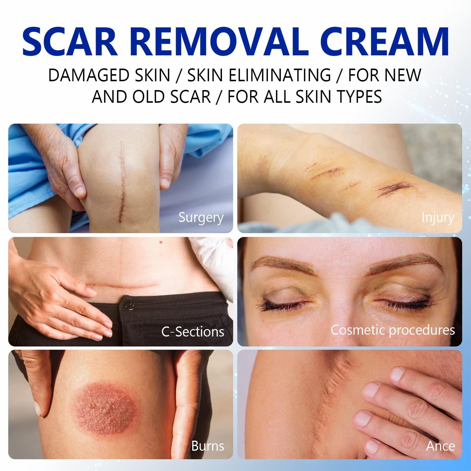 RTBYUE Scar Removal Cream - Advanced Scar Treatment Gel for Surgical Scars, Acne Scars, C-Section, Burns, Stretch Marks - for Old and New Scars