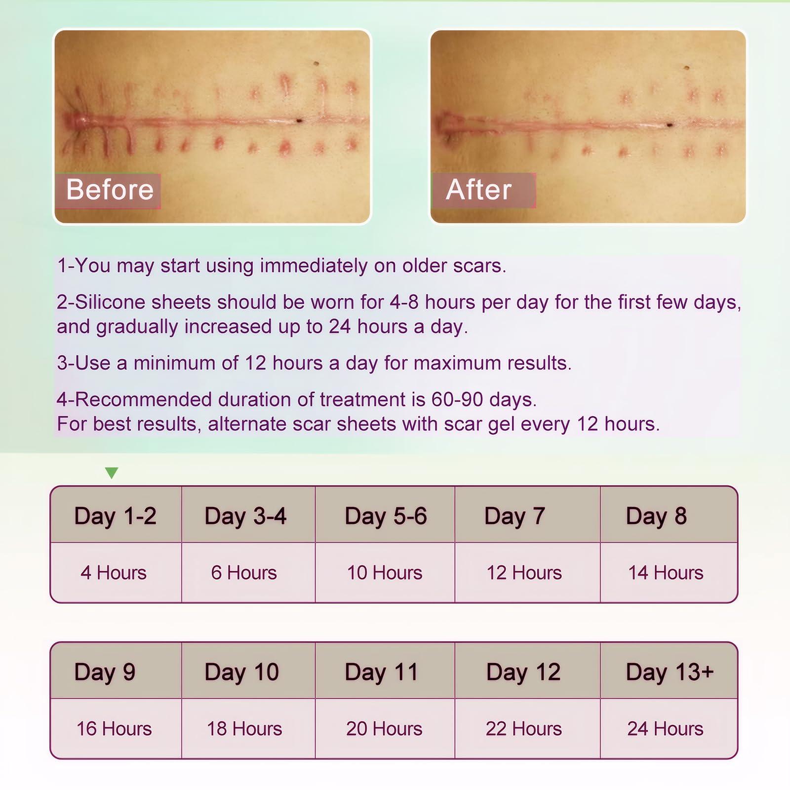 ONE1X Silicone Scar Sheets,Silicone Scar Tape Roll,Medical Grade Silicone Tape for Scar Removal,Reusable Professional Scar Treatment Patch for C-Section,Keloids,Surgical,Acne (Roll Size 1.6\'\'x75\'\'-1.9M)