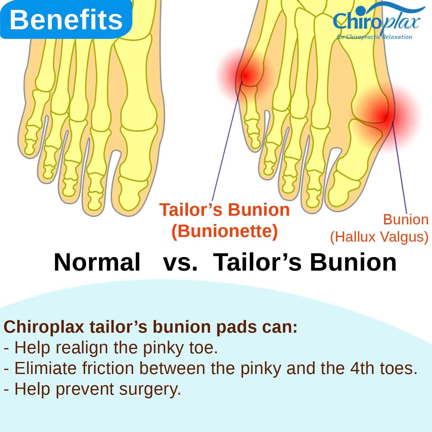 Chiroplax Chiroplax Tailor\'s Bunion Corrector Pads Bunionette Pain Relief Silicone Pinky Toe Straightener Separator Spacer Sleeve Cushion Splint Protector for Men & Women (4 Pads, Shims - Size Small)