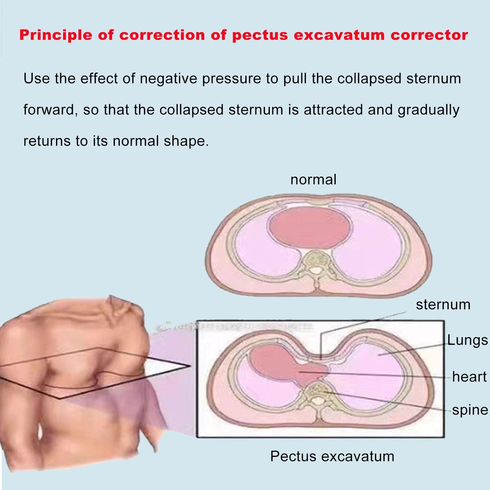 Taeoksn Taeoksn Pectus Carinatum Orthosis Brace,Pigeon Chest Support for Adult,Rib Valgus Correction Belt,Physical Correction of Pectus Carinatum,Free Adjustment(M-M)