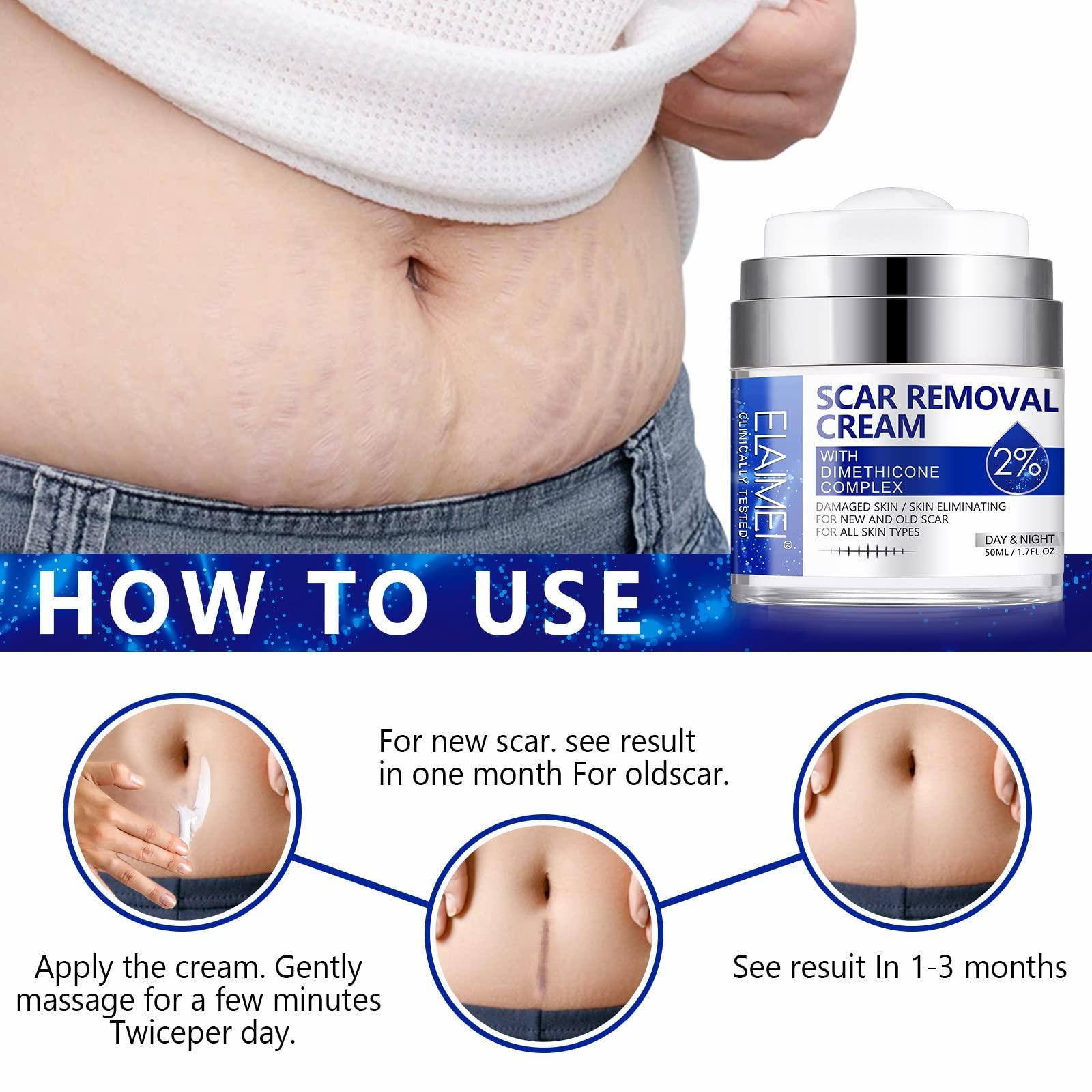 RTBYUE Scar Removal Cream - Advanced Scar Treatment Gel for Surgical Scars, Acne Scars, C-Section, Burns, Stretch Marks - for Old and New Scars