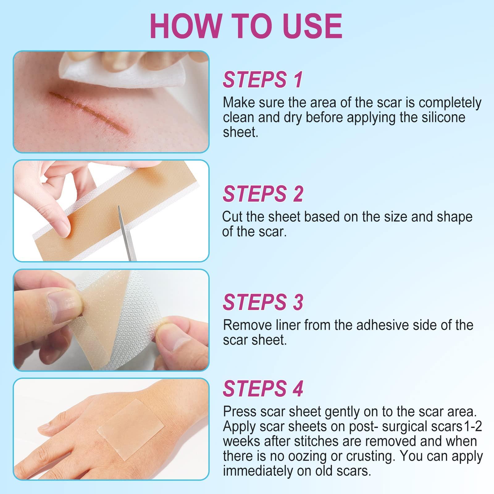 ONE1X Silicone Scar Sheets,Silicone Scar Tape Roll,Medical Grade Silicone Tape for Scar Removal,Reusable Professional Scar Treatment Patch for C-Section,Keloids,Surgical,Acne (Roll Size 1.6\'\'x75\'\'-1.9M)