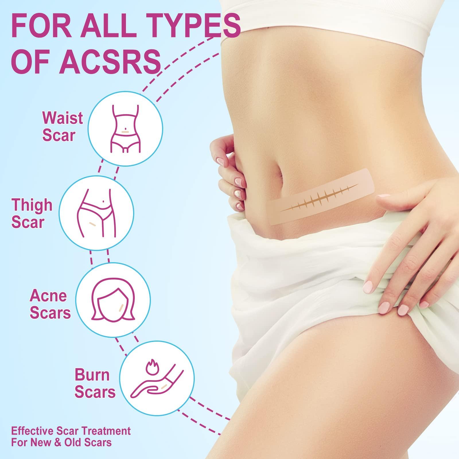 ONE1X Silicone Scar Sheets,Silicone Scar Tape Roll,Medical Grade Silicone Tape for Scar Removal,Reusable Professional Scar Treatment Patch for C-Section,Keloids,Surgical,Acne (Roll Size 1.6\'\'x75\'\'-1.9M)