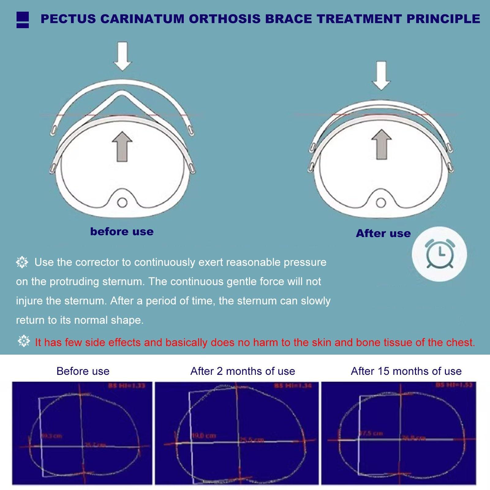 NICHOY NICHOY Pectus Carinatum Orthosis Brace - Deformed Sternum Brace,Pigeon Chest Support for adult,Ribs Valgus Orthosis Braces,Adjustable Size, Comfortable and Breathable(Adjustable model)