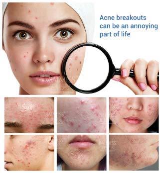 Tink knub BAIMISS Herbal Acne Treatment Cream 1PCS Remove Acne Scar Pimple Face Cream Skin Care Acne Send Removal Needle