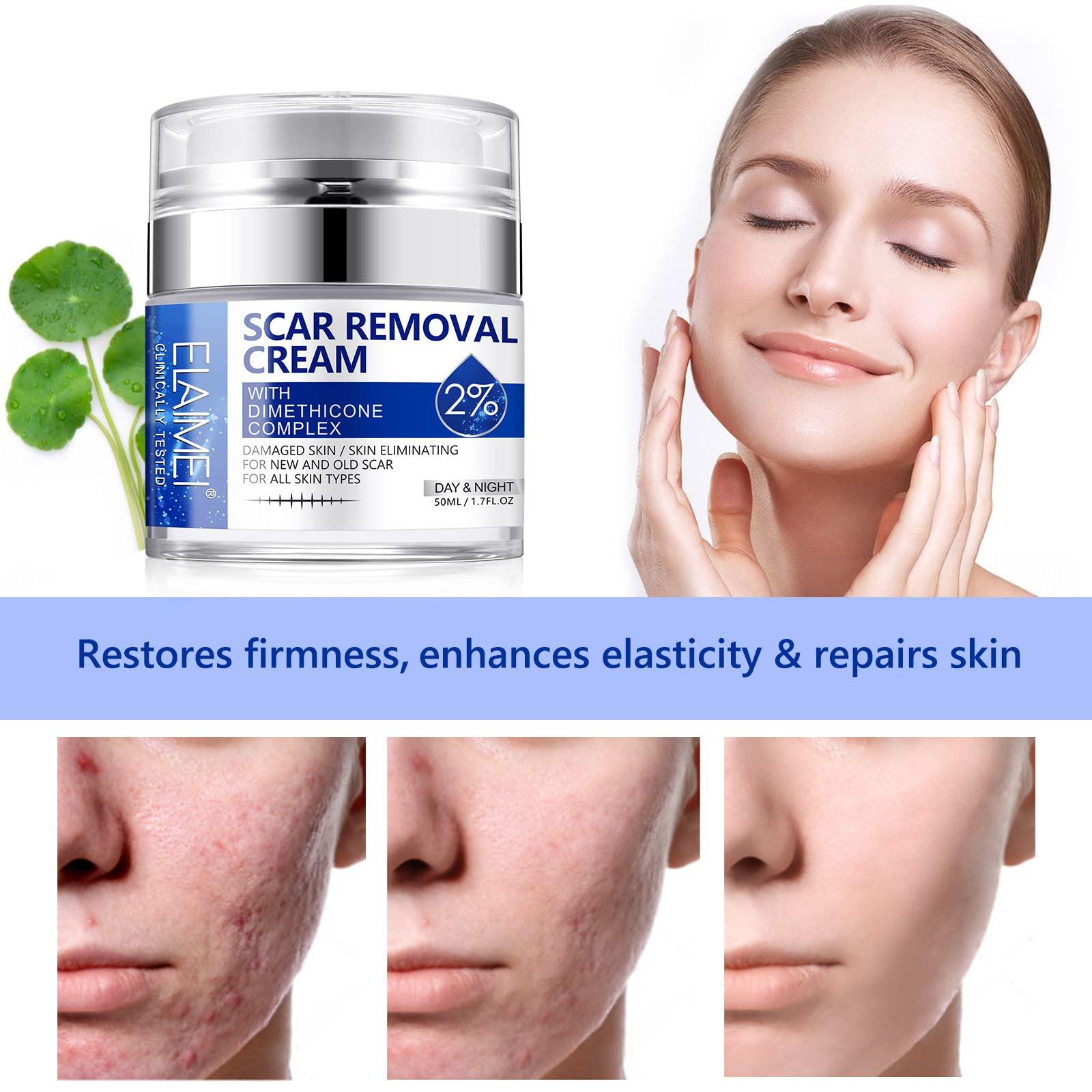 RTBYUE Scar Removal Cream - Advanced Scar Treatment Gel for Surgical Scars, Acne Scars, C-Section, Burns, Stretch Marks - for Old and New Scars