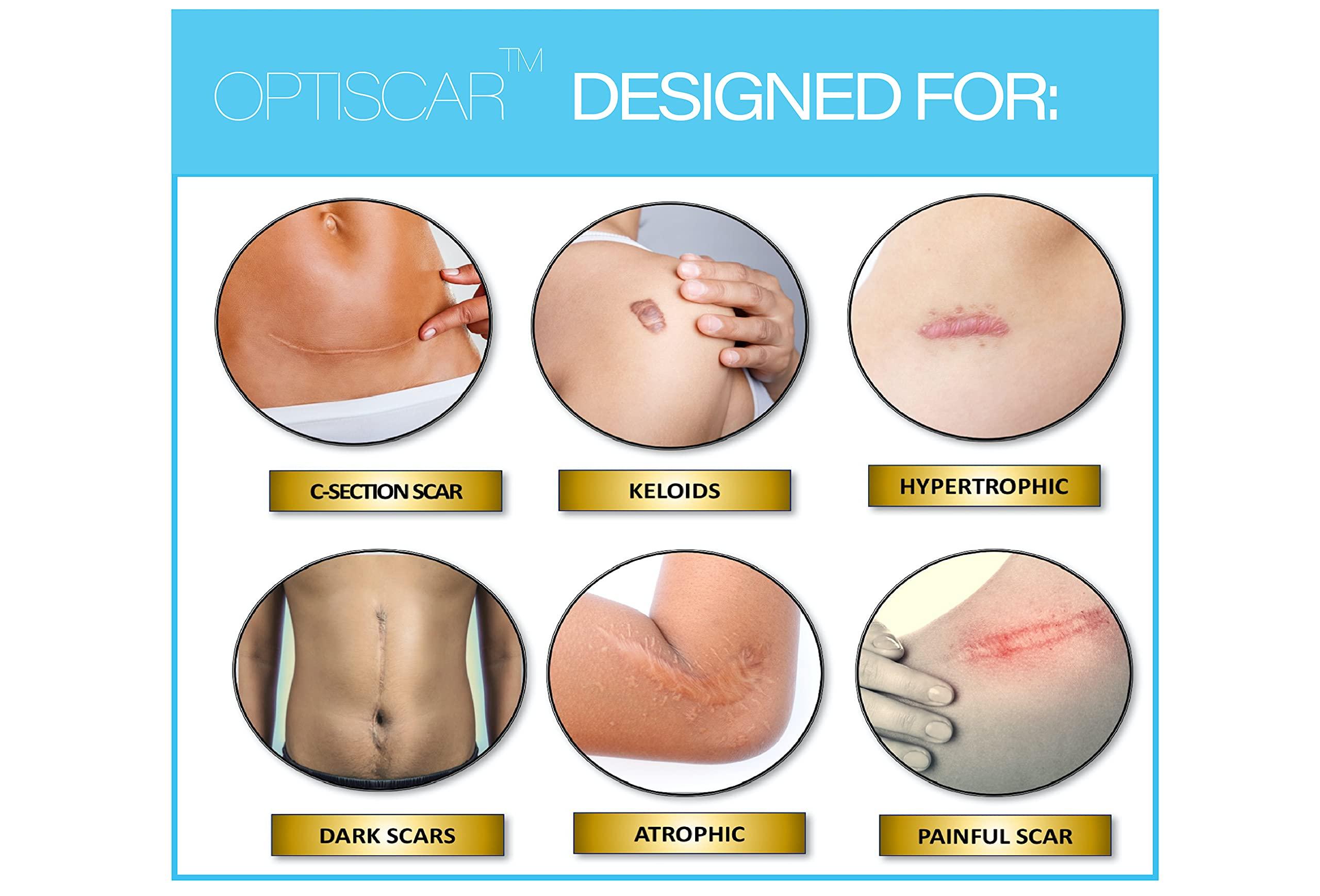 KÈLODA Silicone Scar Tape, Medical Grade Silicone Scar Sheets for Surgical Scars, Tummy Tuck, Lipo, C-Section Post Surgery Scar Treatment, Reusable & Breathable, 1 Roll (60 Sheets)