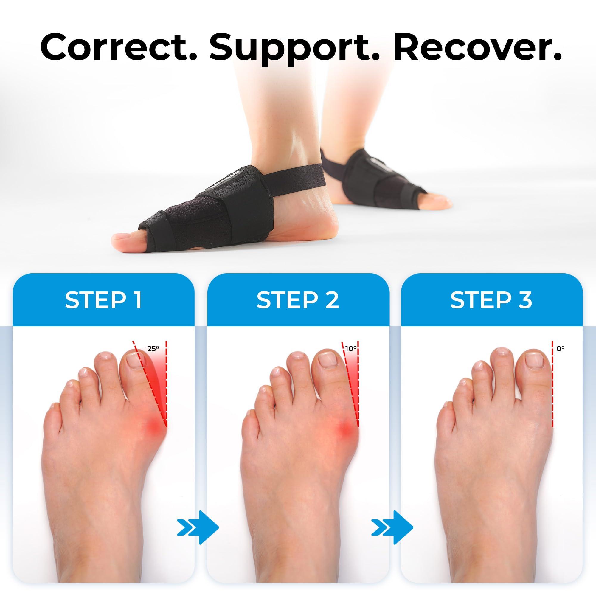 ShrooFit Effective Bunion Corrector for Women and Men | Relieve Pain, Straighten Toes, and Correct Bunions | Orthopedic Toe Straightener | Best Bunion Corrector for Lasting Relief