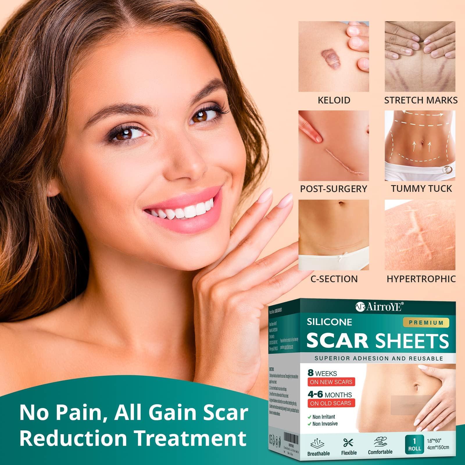 AirroYE Silicone Scar Sheets,Silicone Scar Tape(1.6\"x 60\" Roll-1.5M), Reusable And Effective Scar Removal Sheets, Silicone Scar Removal Sheets For Surgical Scars,Healing Keloid, C-Section, Tummy Tuck