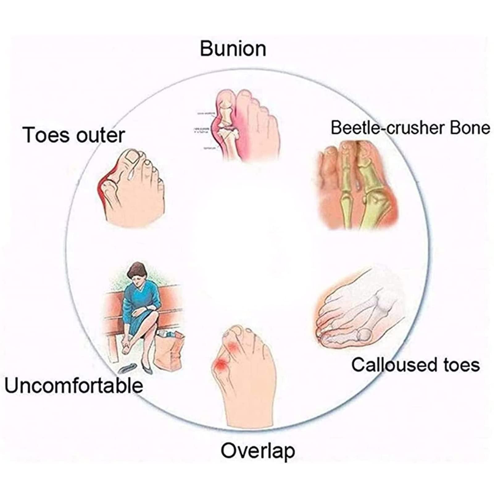 WCXTY WCXTY Ladies Bunion Corrector Flip Flops,Casual Lightweight Orthopedic Beach Sandals for Womens,Strappy Comfy Soft Plantar Fasciitis Slippers,for Hallux Valgus/Arch of Foot (Color : Blue, Size : 6.5)