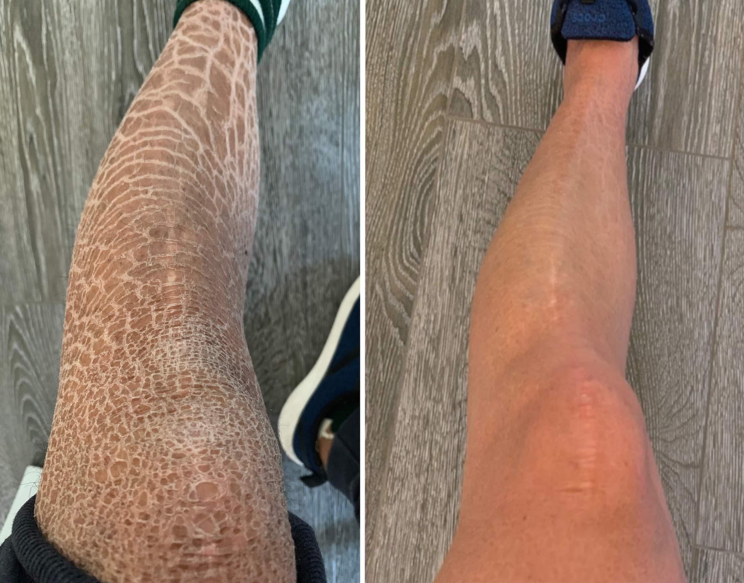 G16 Lotion G16 Skin Repair, Very Dry Skin & Ichthyosis Treatment Cream & Lotion