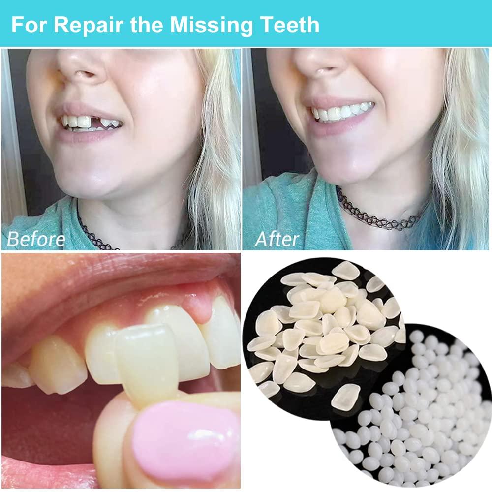 Brige Brige Tooth Repair kit for Filling The Missing Broken Tooth and Gaps-Moldable Fake Teeth and Thermal Beads Replacement Kit