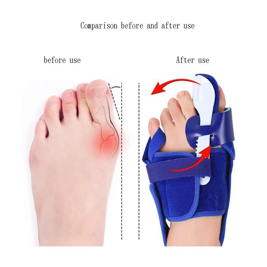 DEAVER DEAVER Hallux Valgus Toe Corrector,Bunion Straightener,Men and Women Splint Reliefbunion Support Splitter Physiotherapy Painless Separator Pain Relief
