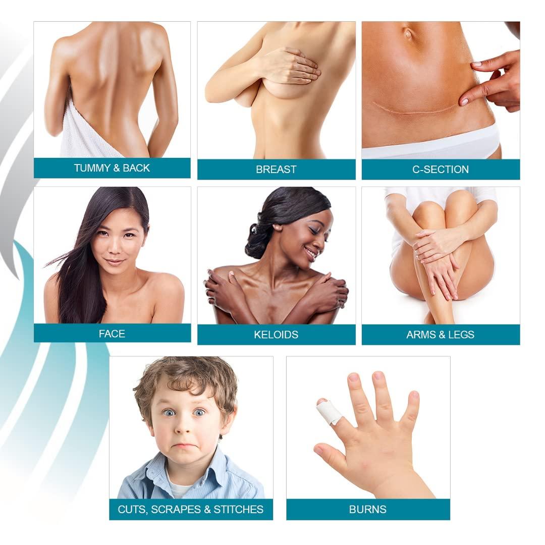 MyNewGel NewGel+ Advanced Silicone Professional Scar Treatment Tape for Irregular Shaped Scars from Surgery, Injury, Keloids, Burns, Reusable, 5\" x 6\" (1 Count) (Clear)