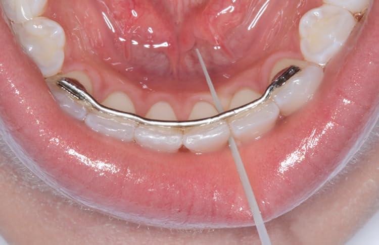 Whitening oral care Opalpix Dental Picks (6 Pack) 32ct per Pack Toothpicks Opalescence Teeth Products Plastic Tooth Dental Pick Oral Care Soft Gum 5590-6