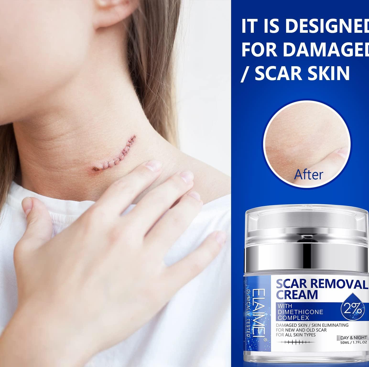 RTBYUE Scar Removal Cream - Advanced Scar Treatment Gel for Surgical Scars, Acne Scars, C-Section, Burns, Stretch Marks - for Old and New Scars