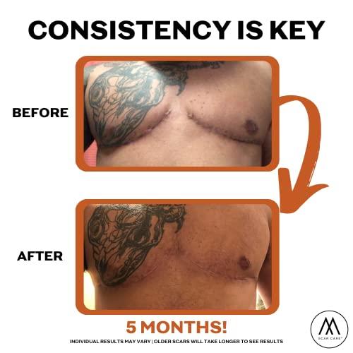 Motivo Scar Care Motivo Advanced Scar Care Bundle: Scar Tape & Roller Serum (10ml) | Water & Sweat Resistant, Long-Lasting, Suitable for All Skin Types | Ideal for Surgical, C-Section, Trauma, & Acne Scars | Espresso