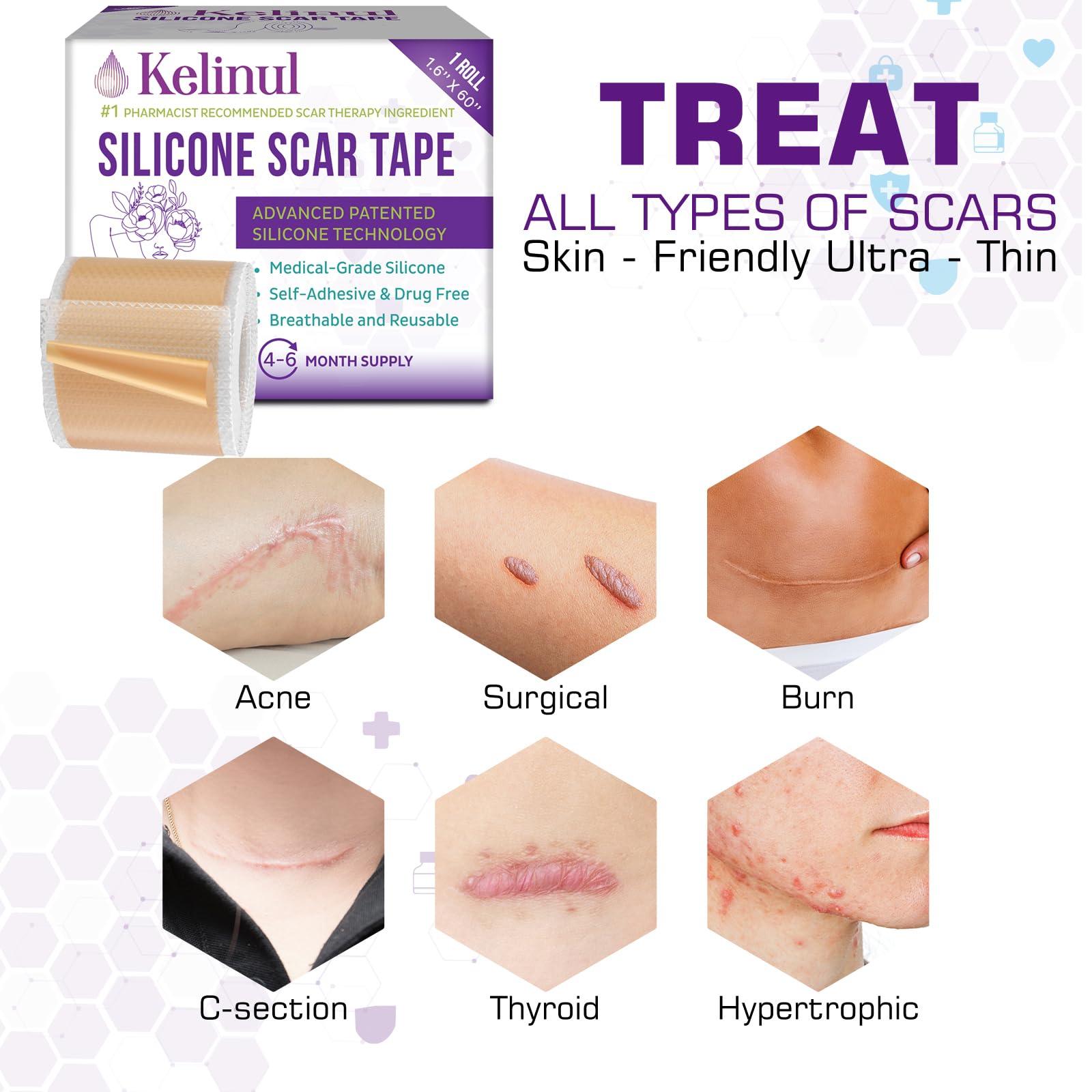 Kelinul Silicone Scar Sheets(1.6\'\' x 60\'\'Roll-1.5M) - Soft Silicone Gel Scar Tape Painless Silicone Tape Roll - Reusable, Medical Grade Silicone Scar Removal Strips for C-Sectio