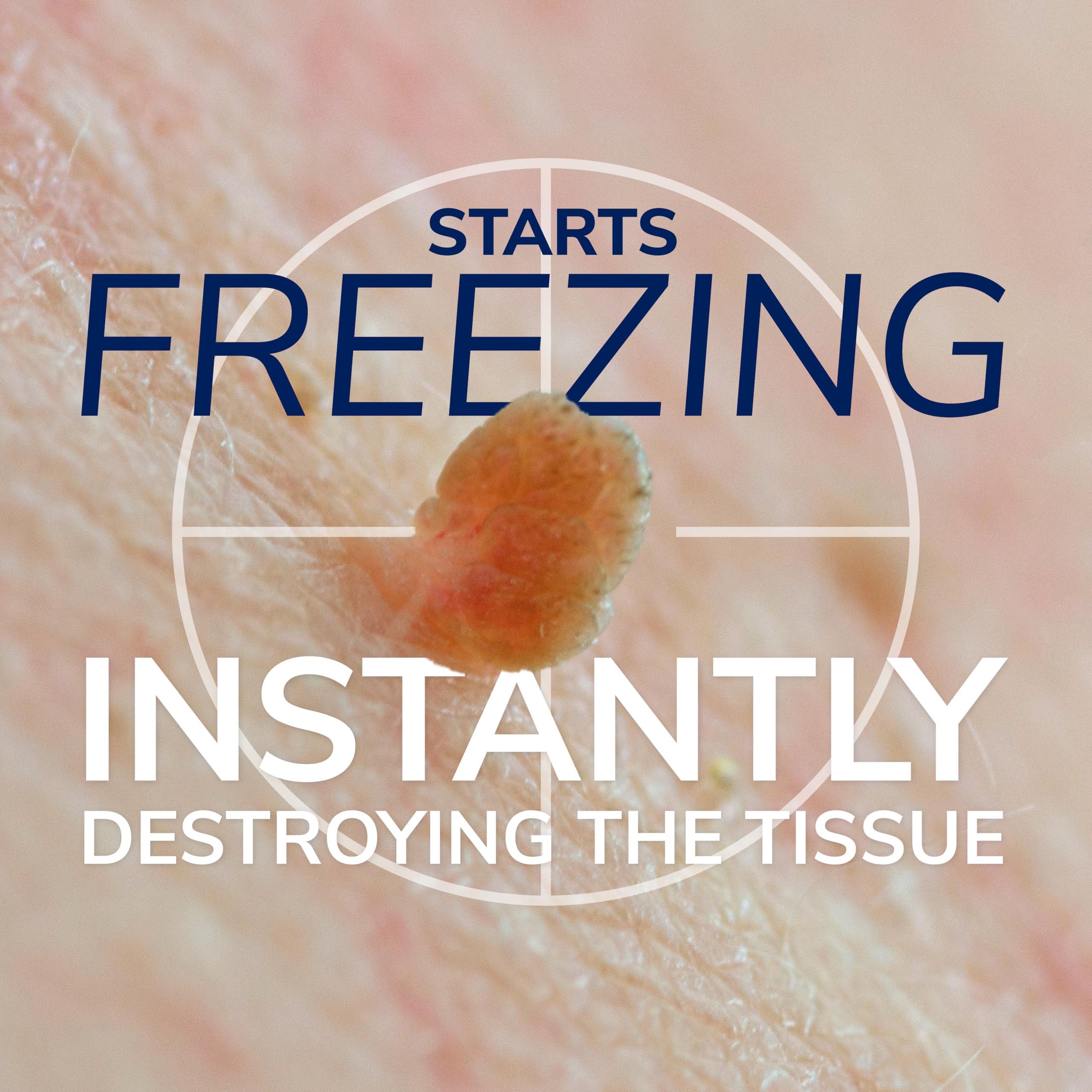 Dr. Scholl's Dr. Scholl's Freeze Away Skin Tag Remover - The First FDA Cleared, at Home Skin tag Removal kit. Clinically Proven Skin tag Removal in as Little as 1 Treatment. 1 Skin tag Removal kit, 8 Treatments.