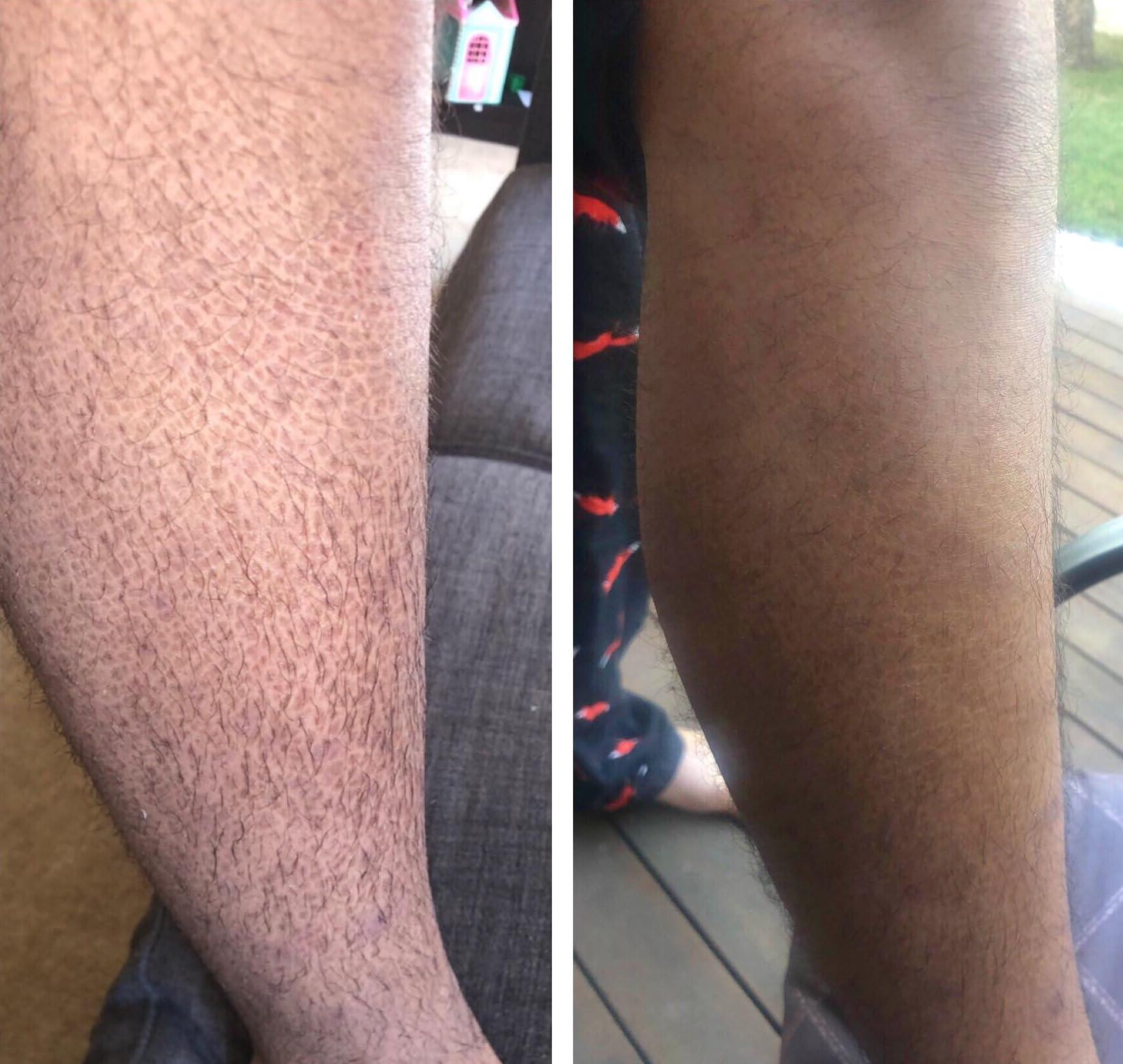 G16 Lotion G16 Skin Repair, Very Dry Skin & Ichthyosis Treatment Cream & Lotion