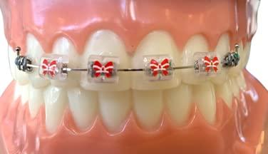 Snapcaps Snapcaps Braces Bumper Cover, Orthodontic Bracket Wax Substitute, Alternative Snap-on Braces Guard Braces Accessories 10 pack (Bow)