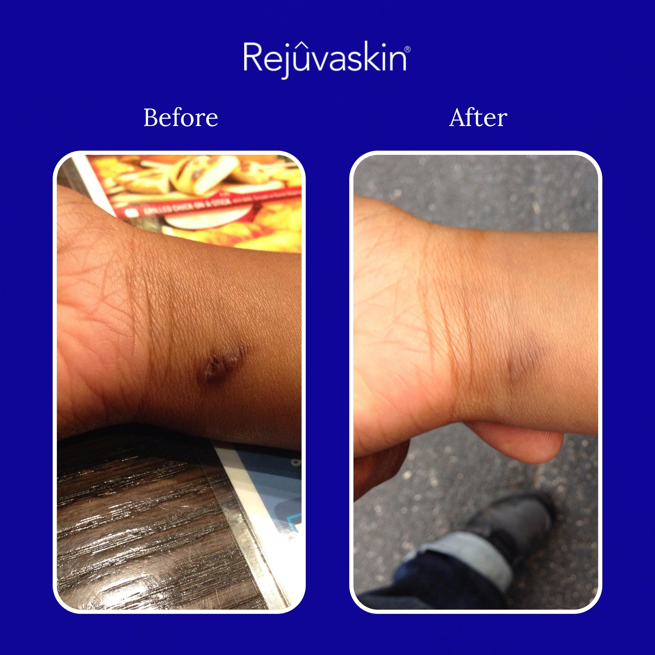 Rejuvaskin Rejuvaskin Scar Fx Silicone Sheeting - 1 Inch x 22 Inches Silicone Scar Tape for Abdominal Scars - Silicone Tape for Soften, Flatten, Reduce and Recover Scars - Physician Recommended - 1 Sheet