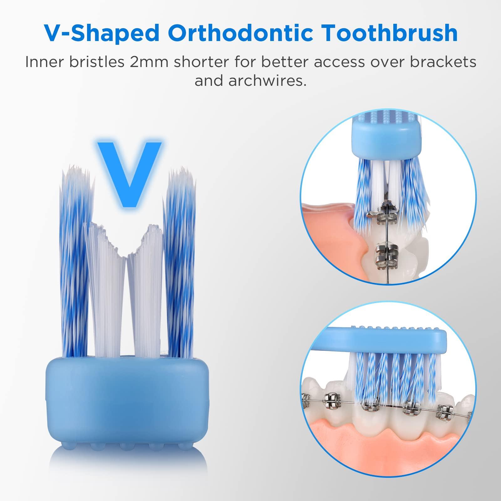 Fremouth Fremouth V-Shaped Orthodontic Toothbrush for Braces, Soft Bristles, 6 Count