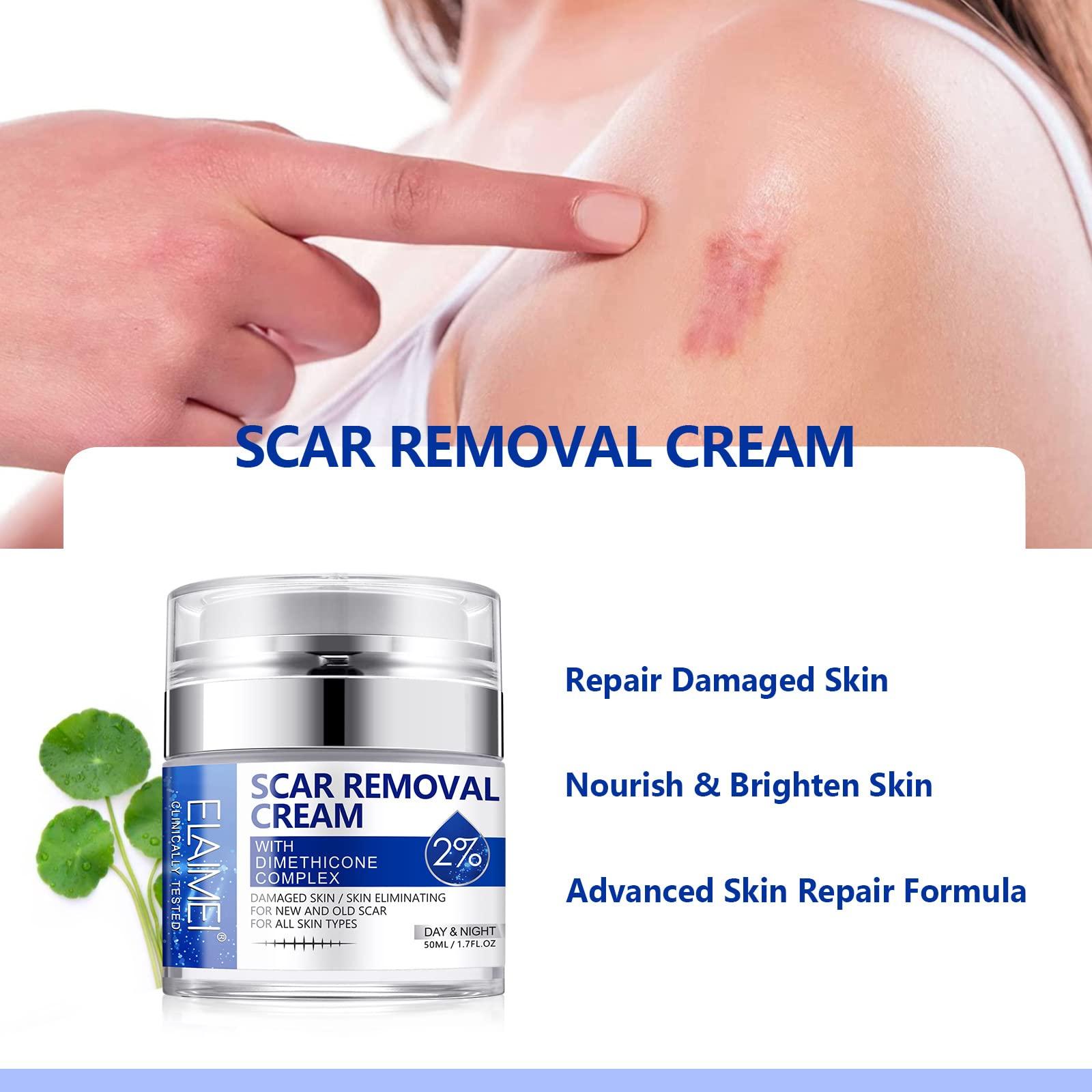 SBHEANGBA Scar Cream, Scar Removal Cream - Advanced Scar Cream for Surgical Scars, Acne Scars, C-Section, Burns, Stretch Marks -Effective for Old and New Scars Gel Acne Scar Treatment