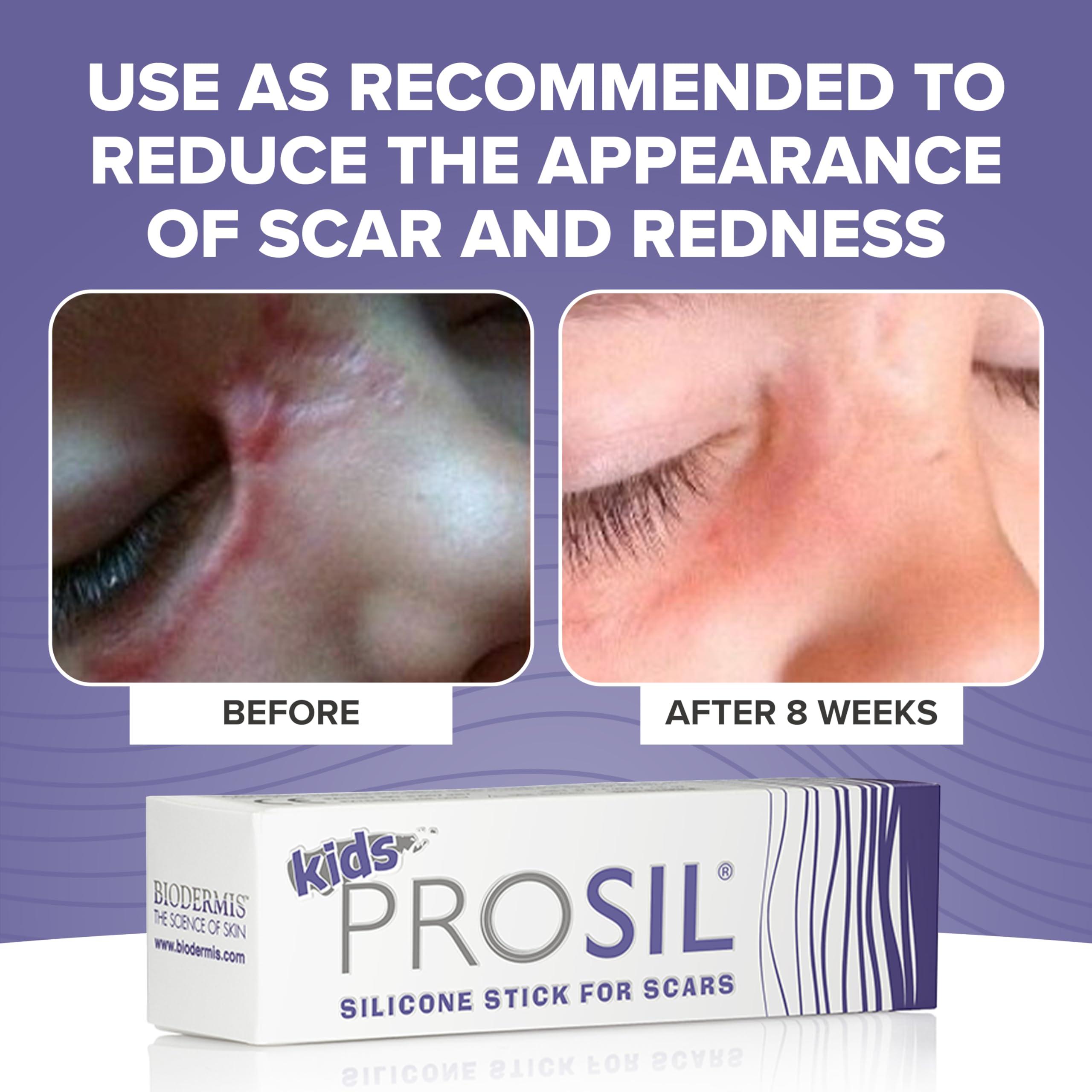 BIODERMIS Kids Pro-Sil 4.25g Silicone Stick for Scars from Biodermis