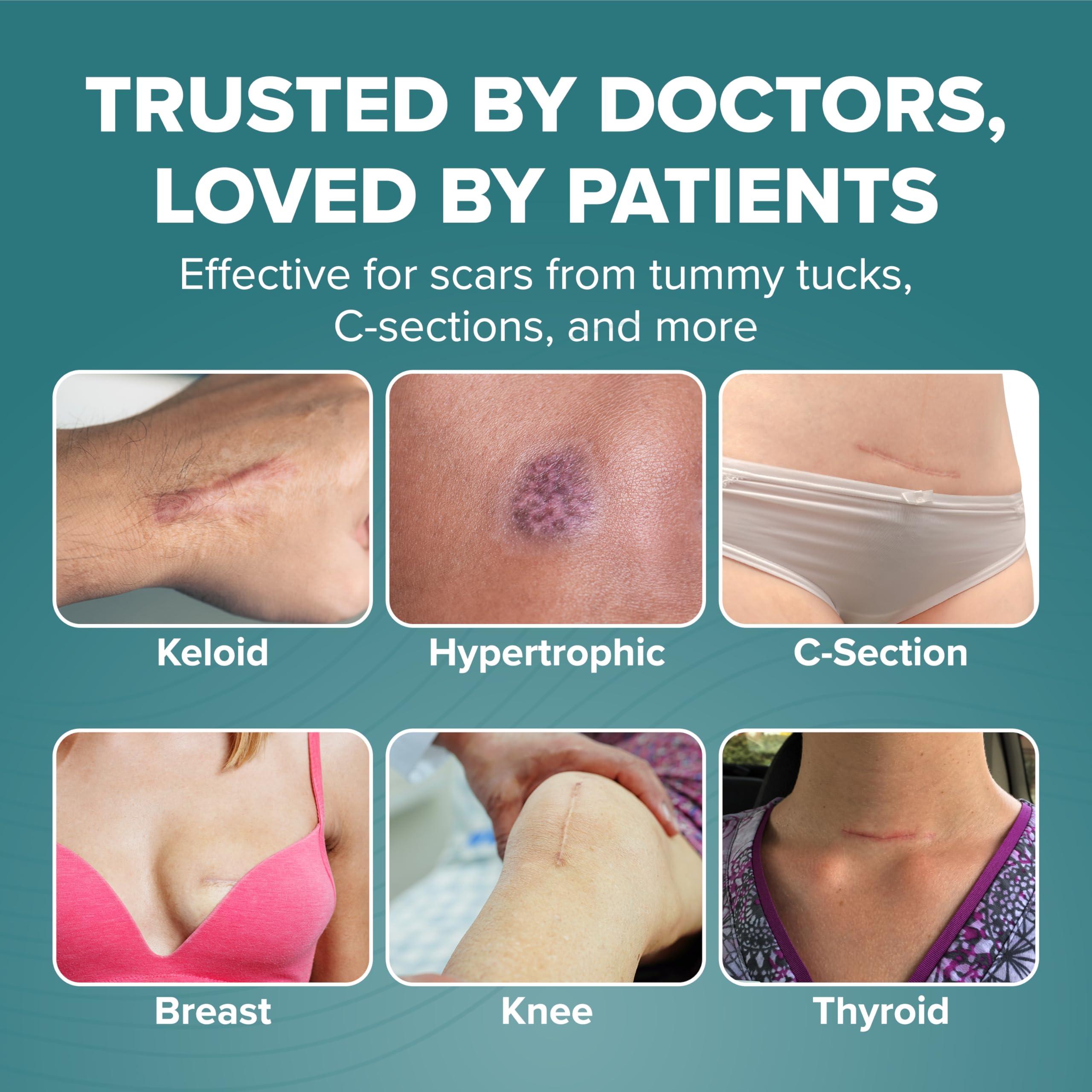 BIODERMIS Epiderm Silicone Gel Scar Sheets - Premium-Grade Silicone Scar Sheets for Optimal Scar Care - Versatile, Flexible & Reusable - Ideal for C-Section, Tummy Tuck & Hysterectomy Scars - 1.4x6 in, Natural